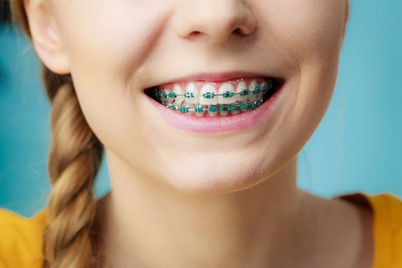 Your Ultimate Guide to Oral Care During Orthodontic Treatment